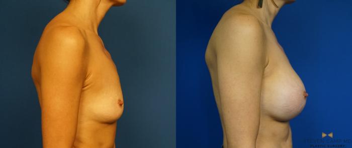 Before & After Breast Augmentation Case 283 View #3 View in Fort Worth & Arlington, Texas