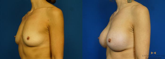 Before & After Breast Augmentation Case 283 View #4 View in Fort Worth & Arlington, Texas
