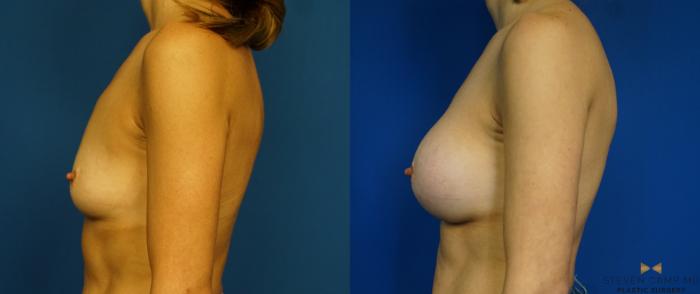 Before & After Breast Augmentation Case 283 View #5 View in Fort Worth & Arlington, Texas