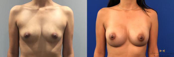 Before & After Breast Augmentation Case 285 View #1 View in Fort Worth & Arlington, Texas