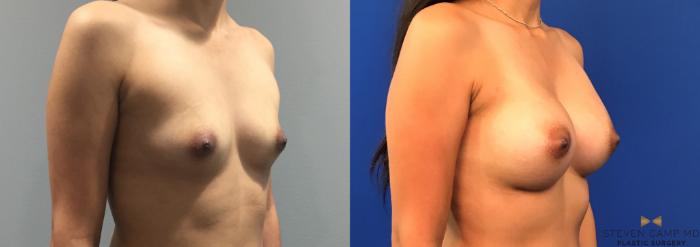 Before & After Breast Augmentation Case 285 View #2 View in Fort Worth & Arlington, Texas