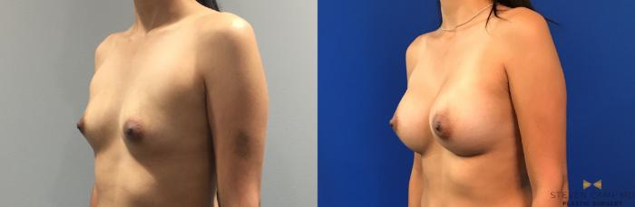 Before & After Breast Augmentation Case 285 View #4 View in Fort Worth & Arlington, Texas