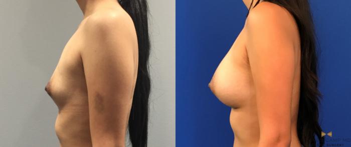 Before & After Breast Augmentation Case 285 View #5 View in Fort Worth & Arlington, Texas
