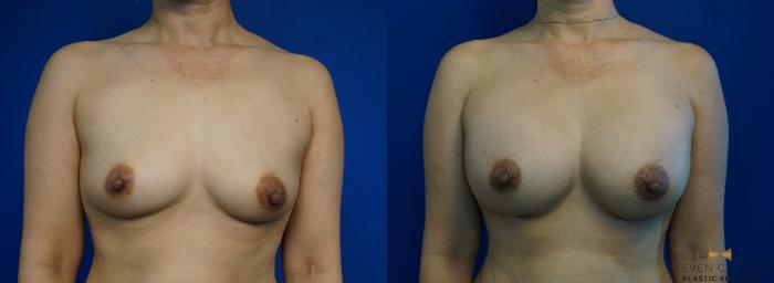 Before & After Breast Augmentation Case 286 View #1 View in Fort Worth & Arlington, Texas
