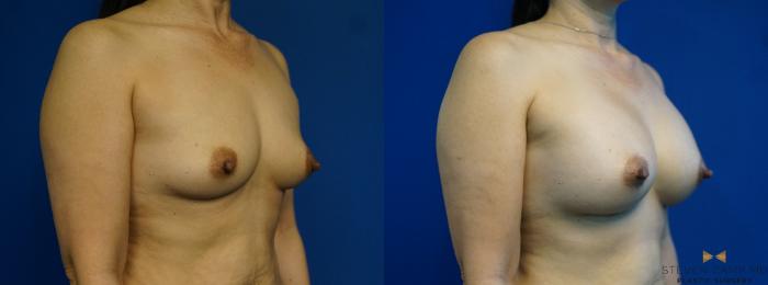 Before & After Breast Augmentation Case 286 View #2 View in Fort Worth & Arlington, Texas