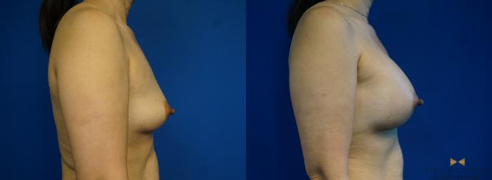 Before & After Breast Augmentation Case 286 View #3 View in Fort Worth & Arlington, Texas