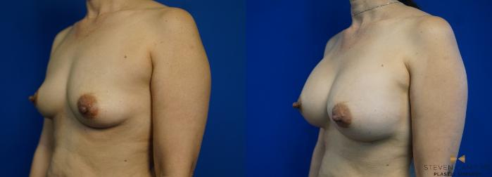 Before & After Breast Augmentation Case 286 View #4 View in Fort Worth & Arlington, Texas