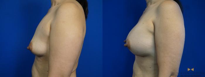Before & After Breast Augmentation Case 286 View #5 View in Fort Worth & Arlington, Texas