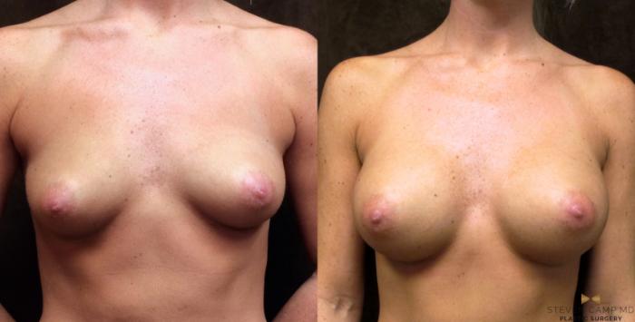Before & After Breast Augmentation Case 31 View #1 View in Fort Worth, Texas