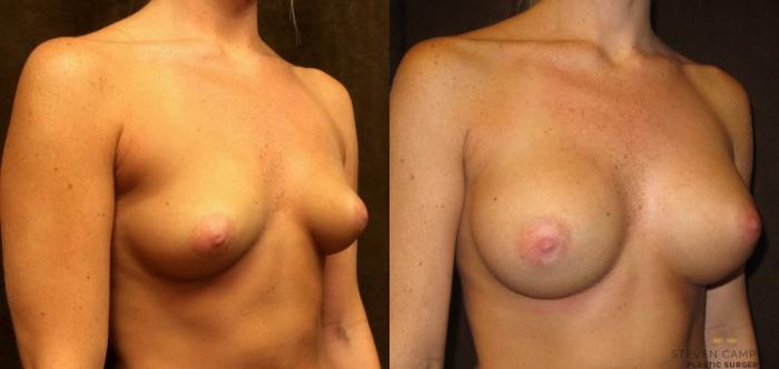 Before & After Breast Augmentation Case 31 View #2 View in Fort Worth, Texas