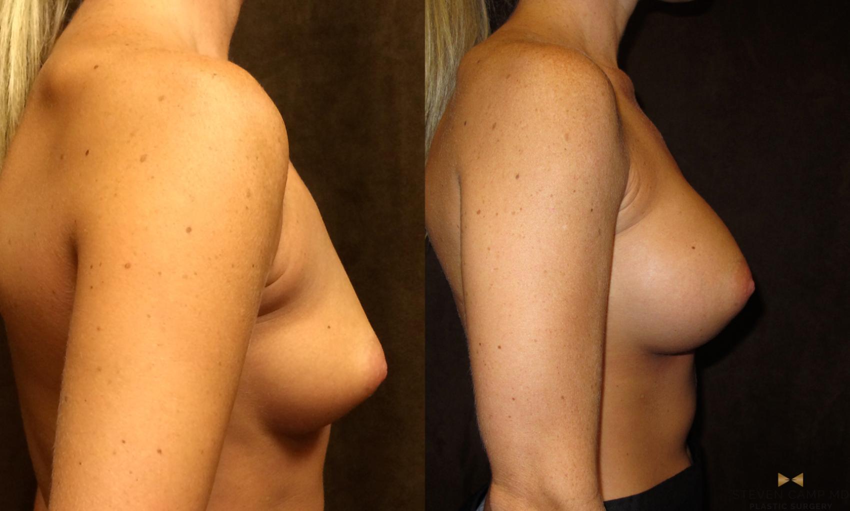 Before & After Breast Augmentation Case 31 View #3 View in Fort Worth, Texas