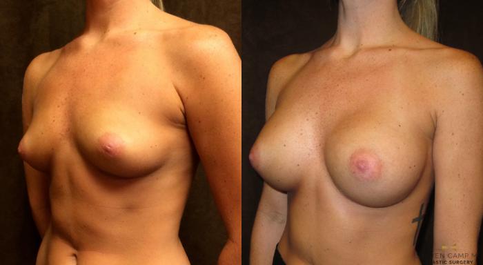 Before & After Breast Augmentation Case 31 View #4 View in Fort Worth, Texas