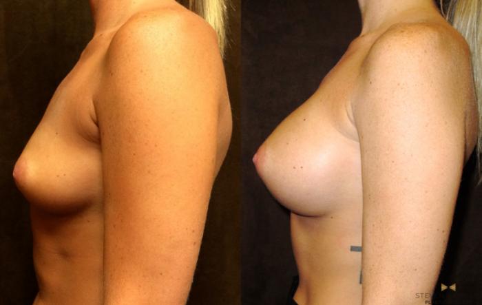 Before & After Breast Augmentation Case 31 View #5 View in Fort Worth, Texas
