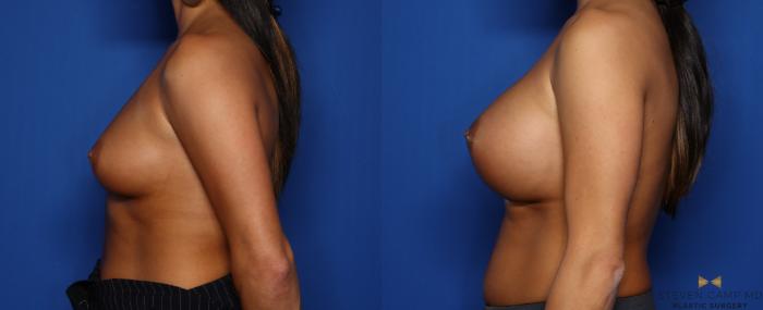 Before & After Breast Augmentation Case 319 Left Side View in Fort Worth, Texas
