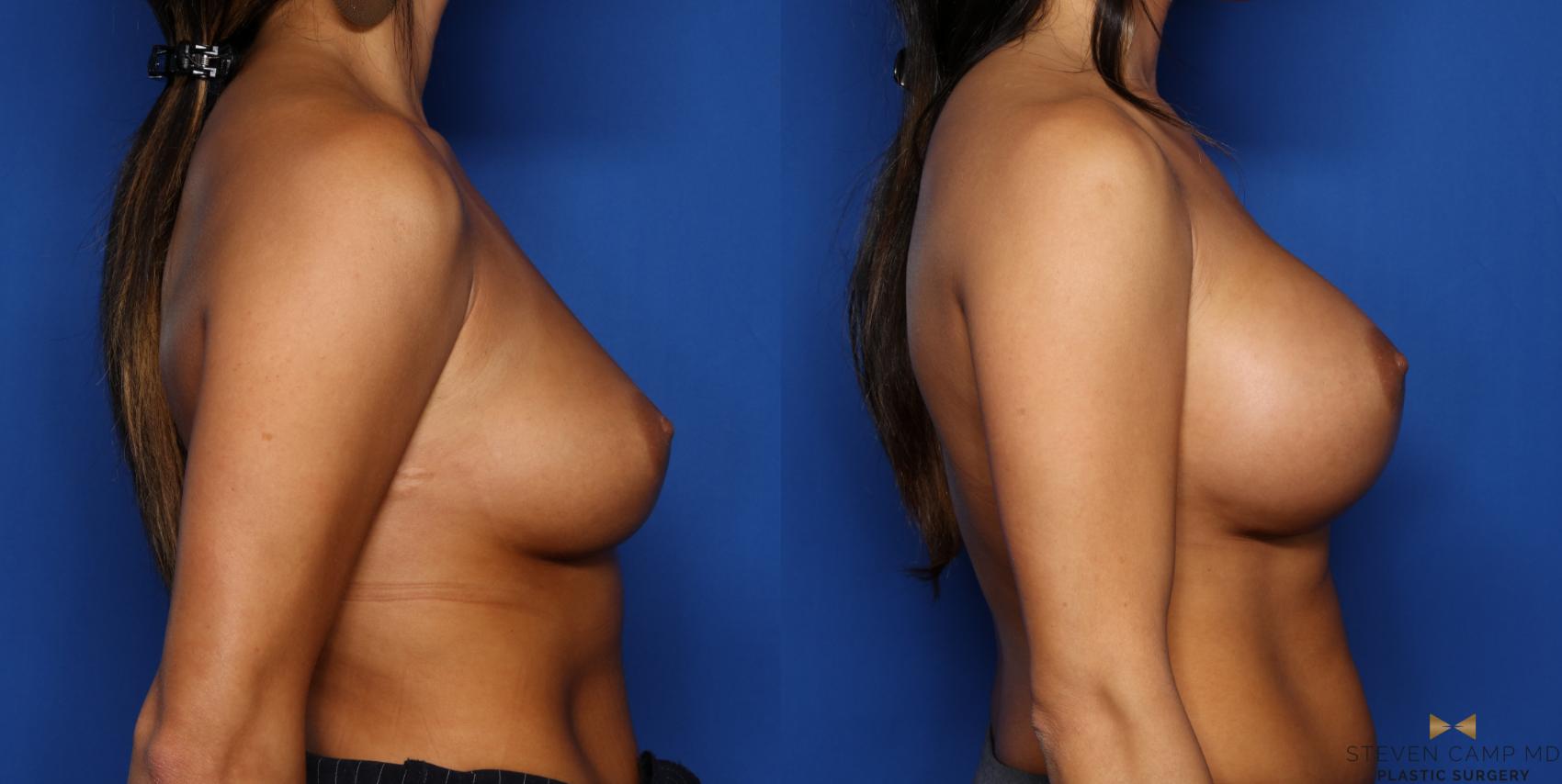 Before & After Breast Augmentation Case 319 Right Side View in Fort Worth & Arlington, Texas