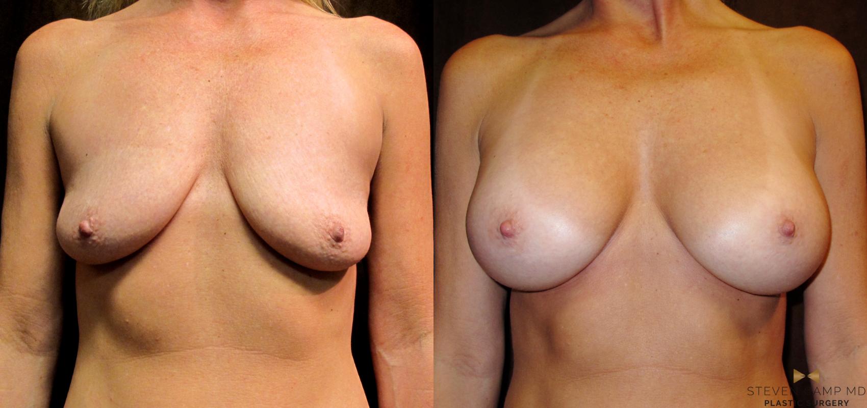 Before & After Case2912 by Steven Camp MD Plastic Surgery & Aesthetics, in Fort Worth