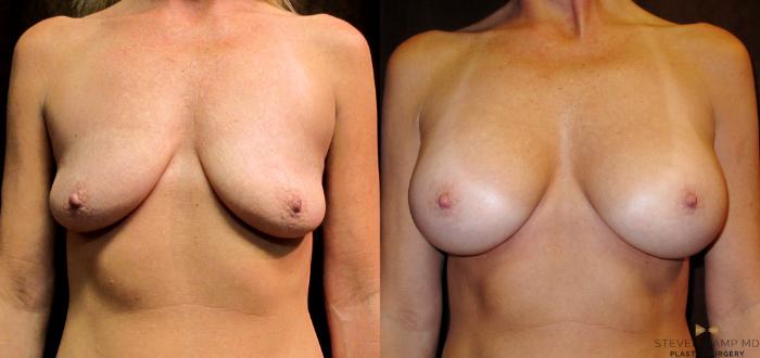 Before & After Breast Augmentation Case 32 View #1 View in Fort Worth, Texas