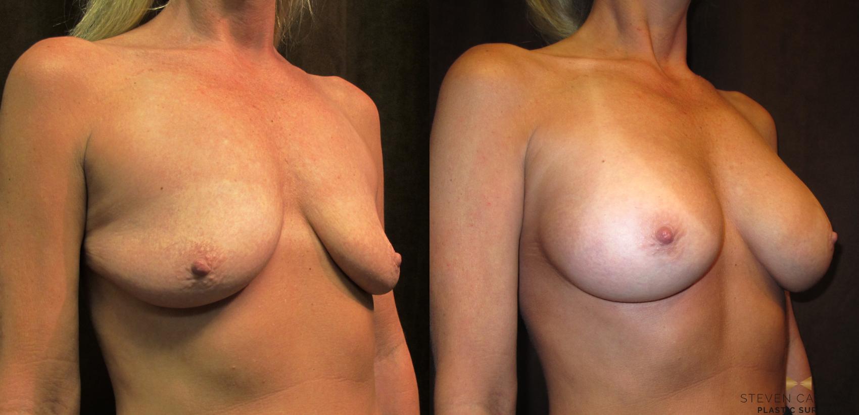 Before & After Breast Augmentation Case 32 View #2 View in Fort Worth, Texas