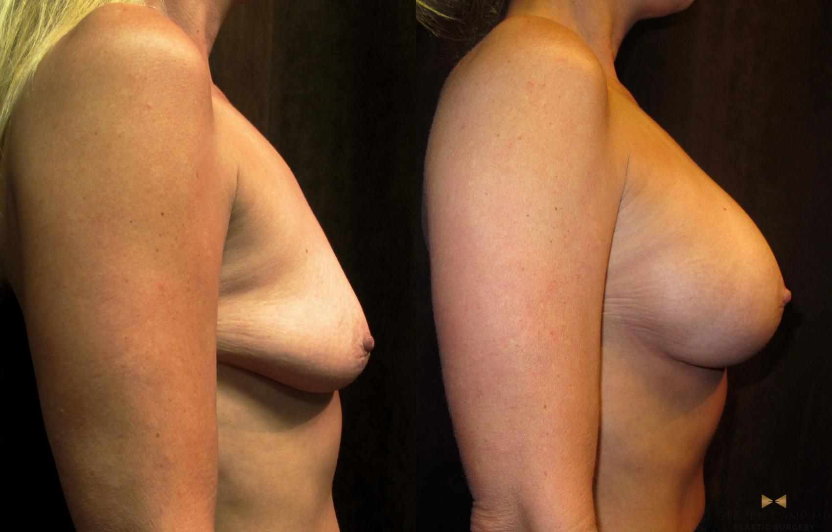 Before & After Breast Augmentation Case 32 View #3 View in Fort Worth, Texas