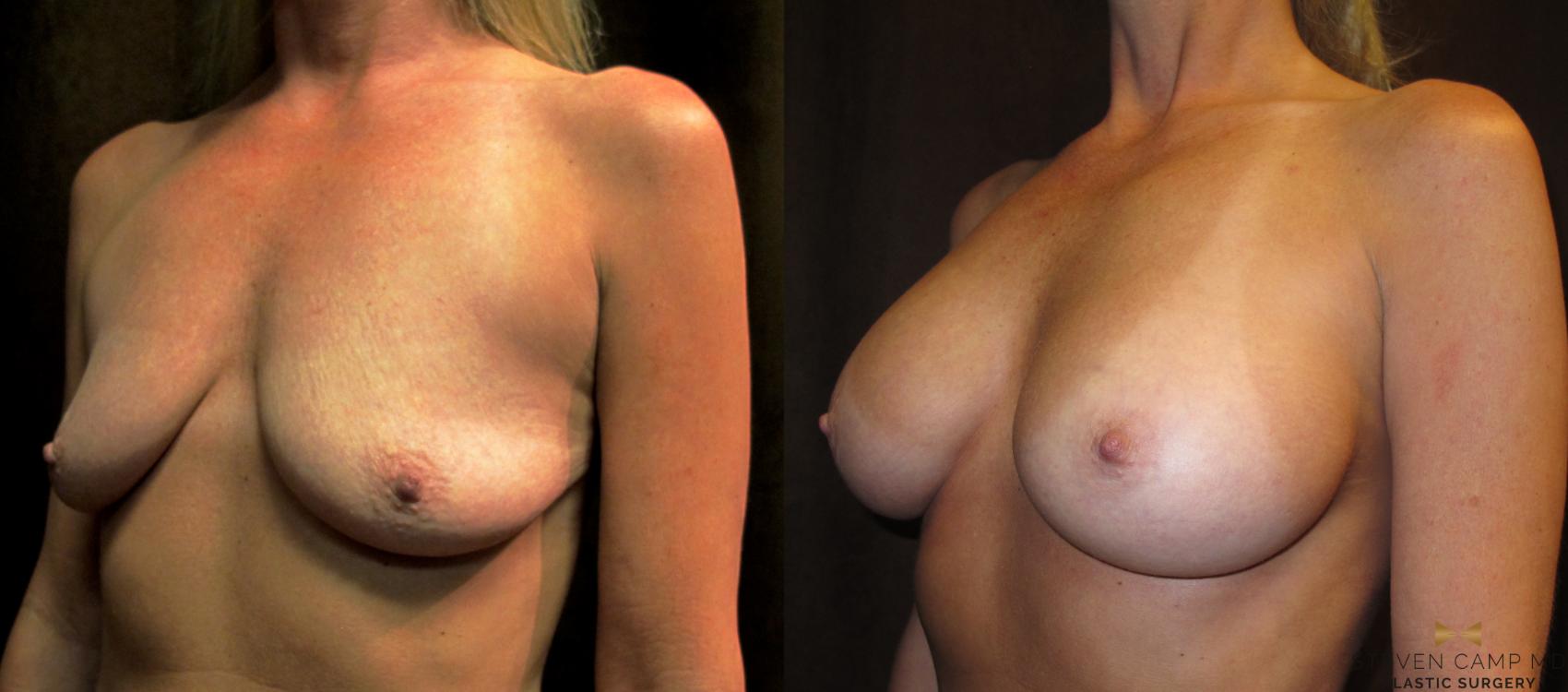 Before & After Breast Augmentation Case 32 View #4 View in Fort Worth, Texas