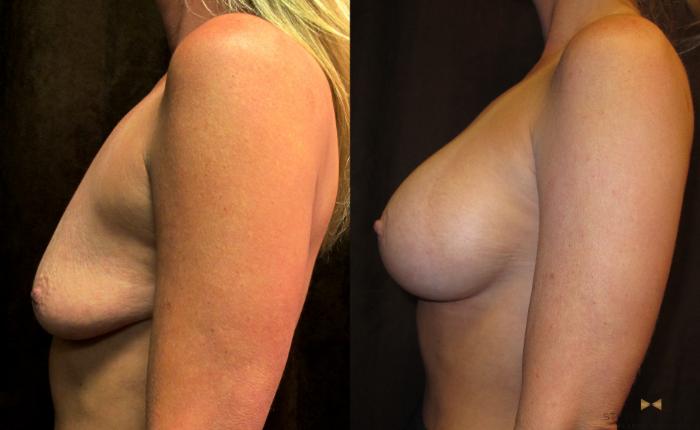 Before & After Breast Augmentation Case 32 View #5 View in Fort Worth, Texas
