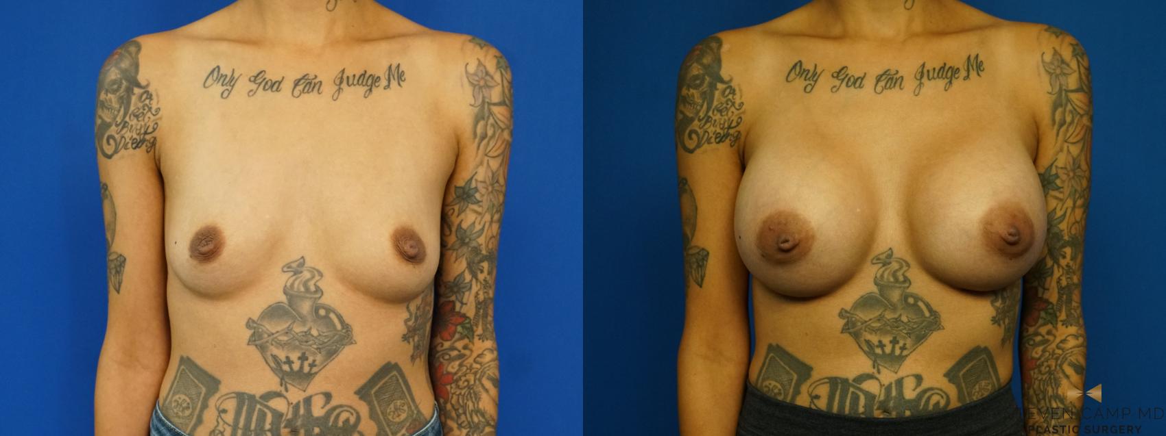 Before & After Breast Augmentation Case 328 Front View in Fort Worth, Texas