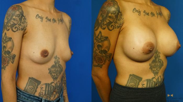 Before & After Breast Augmentation Case 328 Right Oblique View in Fort Worth & Arlington, Texas