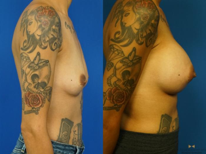 Before & After Breast Augmentation Case 328 Right Side View in Fort Worth & Arlington, Texas
