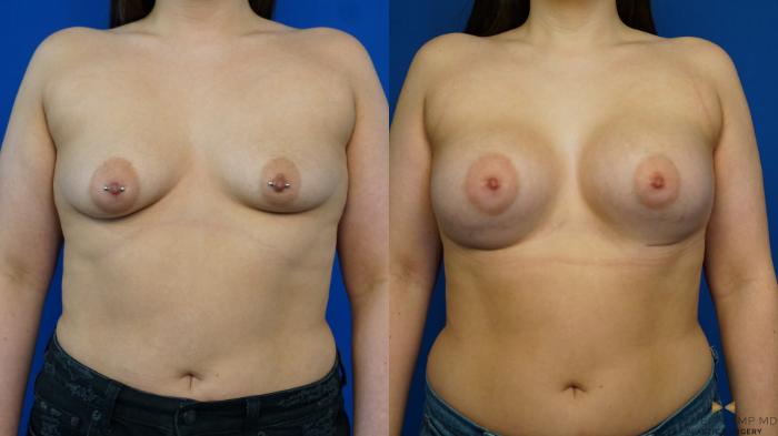 Before & After Breast Augmentation Case 329 Front View in Fort Worth & Arlington, Texas