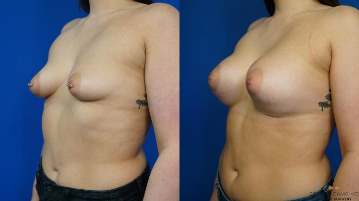 Before & After Breast Augmentation Case 329 Left Oblique View in Fort Worth & Arlington, Texas