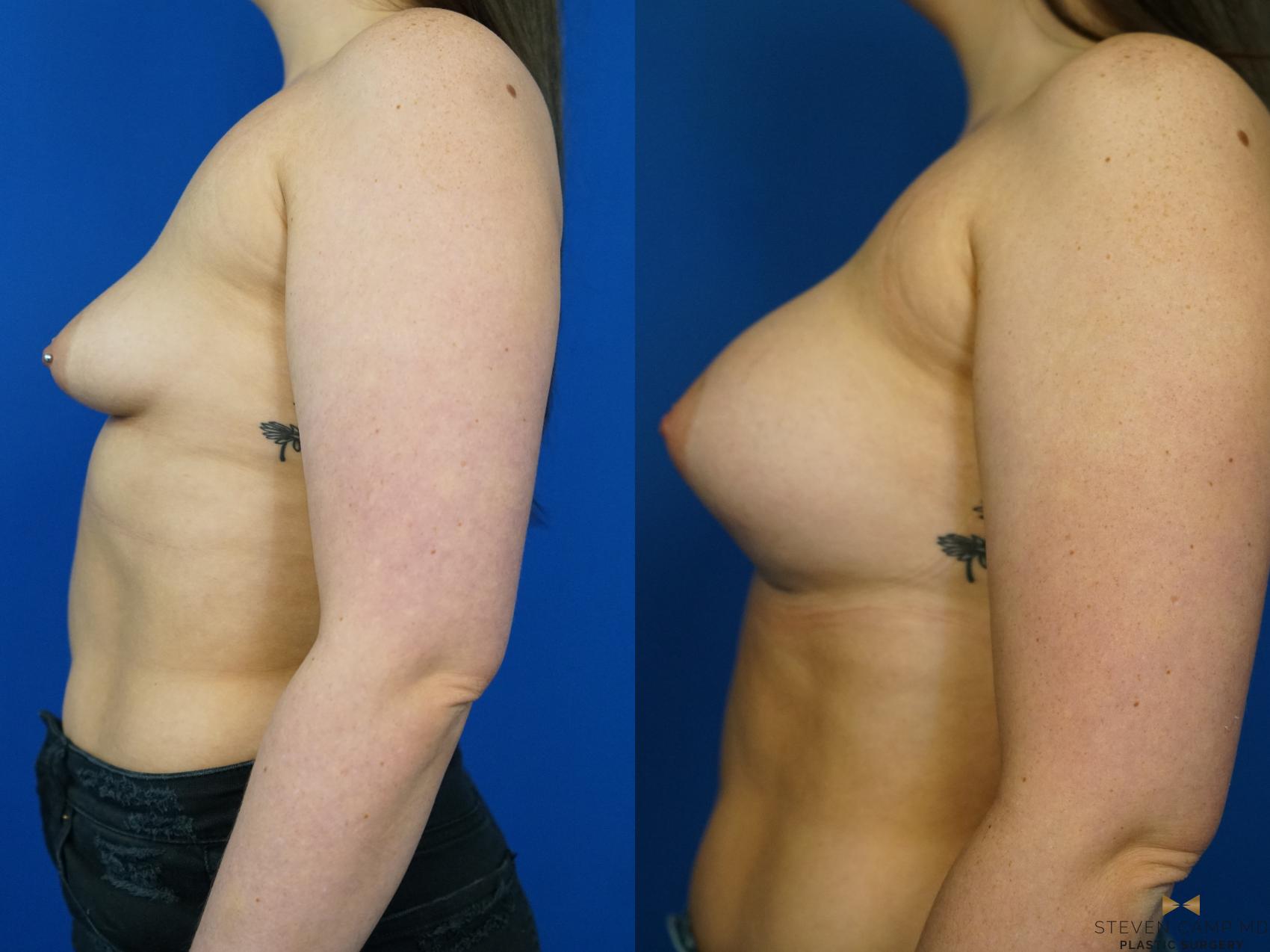 Before & After Breast Augmentation Case 329 Left Side View in Fort Worth & Arlington, Texas