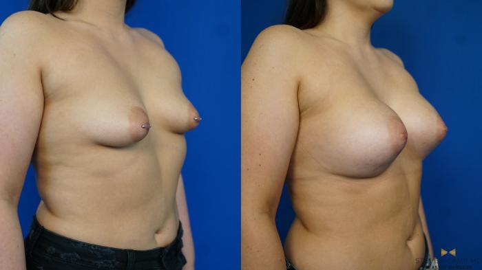 Before & After Breast Augmentation Case 329 Right Oblique View in Fort Worth & Arlington, Texas