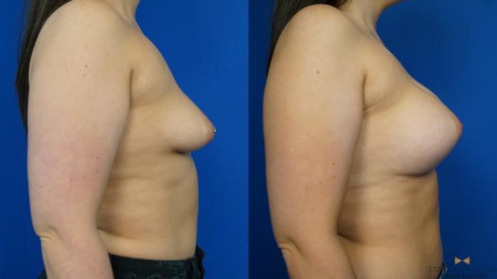 Before & After Breast Augmentation Case 329 Right Side View in Fort Worth & Arlington, Texas