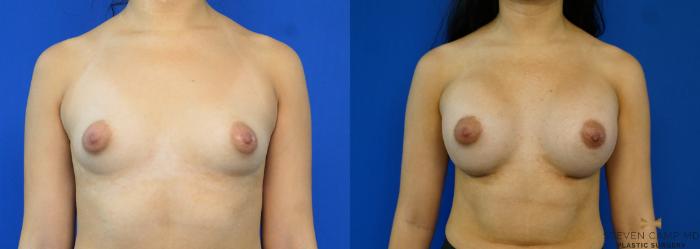 Before & After Breast Augmentation Case 330 Front View in Fort Worth & Arlington, Texas