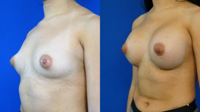 Before & After Breast Augmentation Case 330 Left Oblique View in Fort Worth & Arlington, Texas