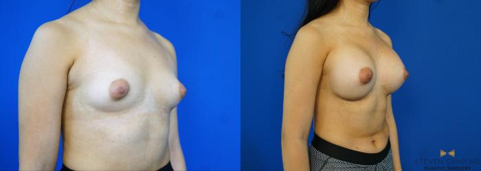 Before & After Breast Augmentation Case 330 Right Oblique View in Fort Worth & Arlington, Texas
