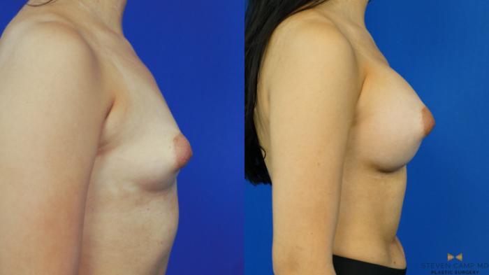 Before & After Breast Augmentation Case 330 Right Side View in Fort Worth & Arlington, Texas