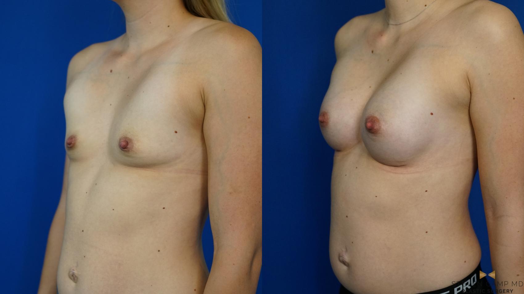 Before & After Breast Augmentation Case 342 Left Oblique View in Fort Worth & Arlington, Texas
