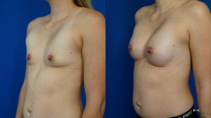 Before & After Breast Augmentation Case 342 Left Oblique View in Fort Worth, Texas