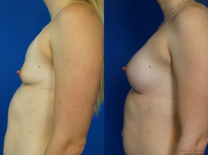 Before & After Breast Augmentation Case 342 Left Side View in Fort Worth, Texas