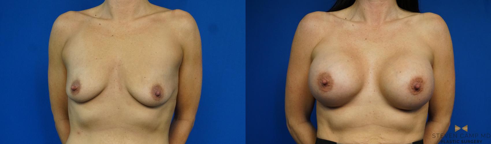 Before & After Breast Augmentation Case 343 Front View in Fort Worth & Arlington, Texas