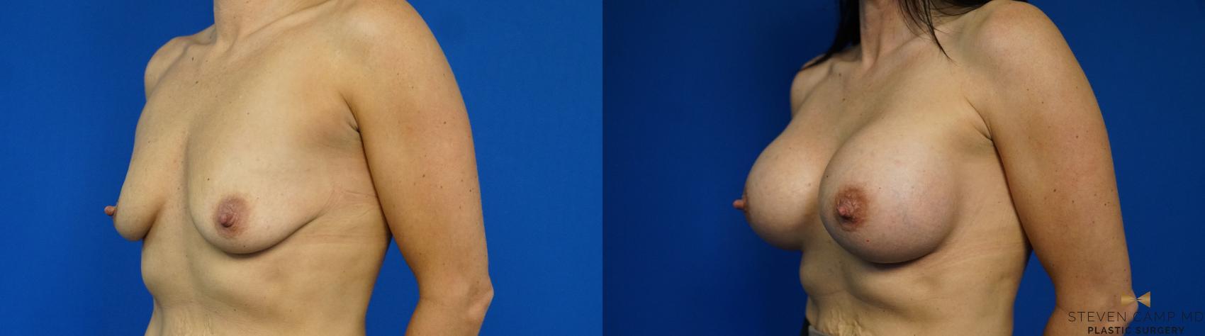 Before & After Breast Augmentation Case 343 Left Oblique View in Fort Worth & Arlington, Texas