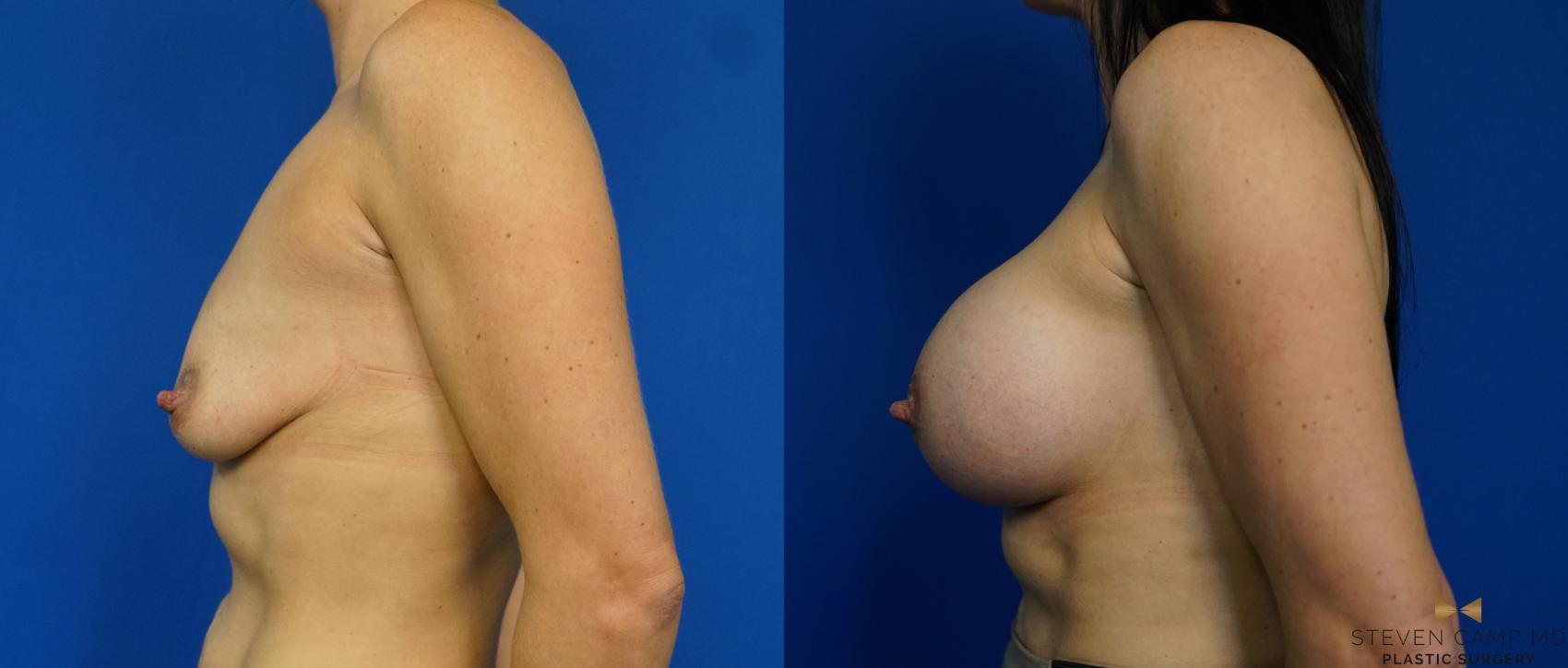 Before & After Breast Augmentation Case 343 Left Side View in Fort Worth, Texas