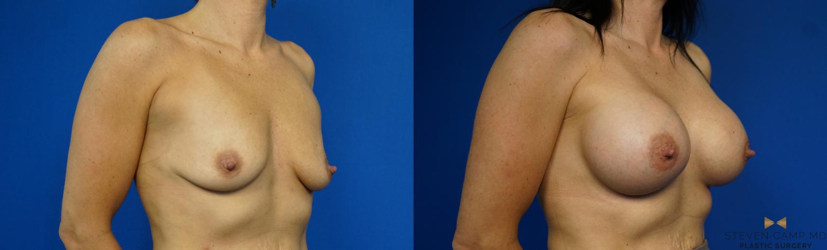 Before & After Breast Augmentation Case 343 Right Oblique View in Fort Worth & Arlington, Texas