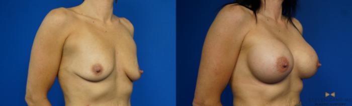 Before & After Breast Augmentation Case 343 Right Oblique View in Fort Worth, Texas