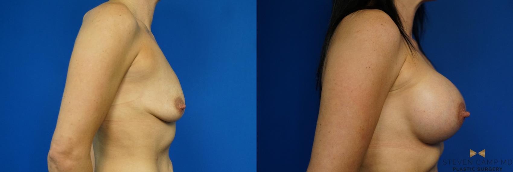 Before & After Breast Augmentation Case 343 Right Side View in Fort Worth & Arlington, Texas