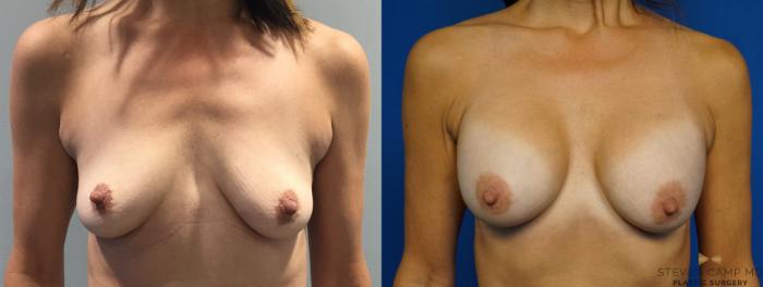 Before & After Breast Augmentation Case 347 Front View in Fort Worth & Arlington, Texas