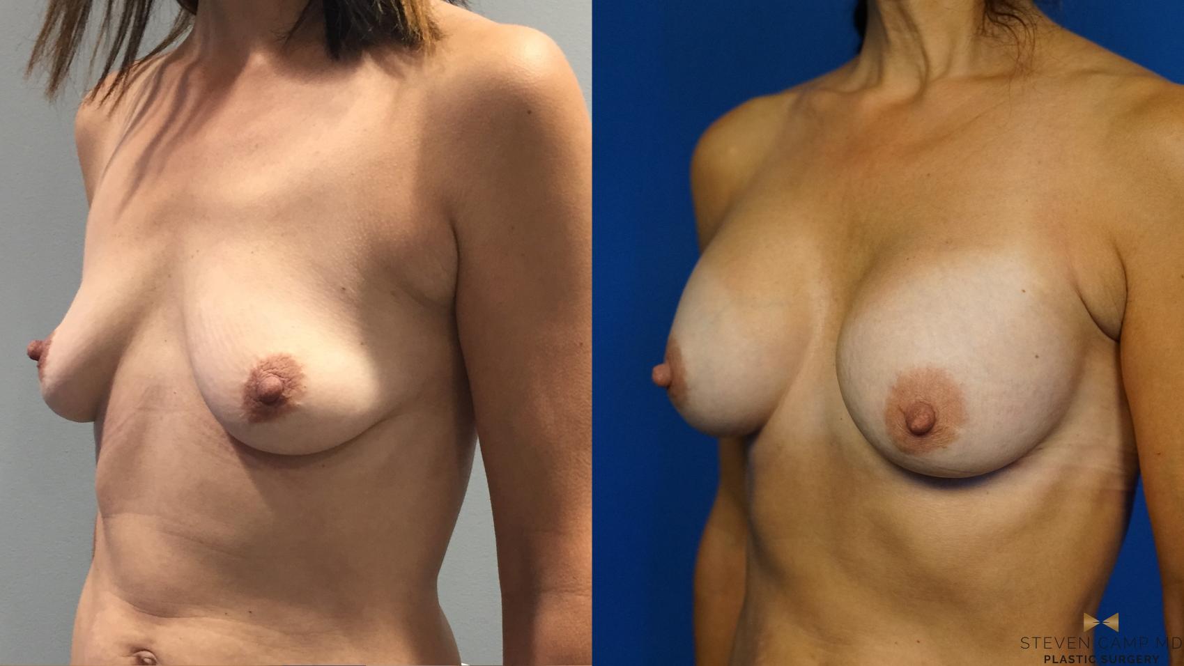 Before & After Breast Augmentation Case 347 Left Oblique View in Fort Worth & Arlington, Texas