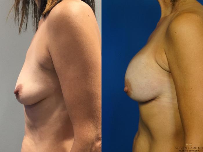 Before & After Breast Augmentation Case 347 Left Side View in Fort Worth & Arlington, Texas