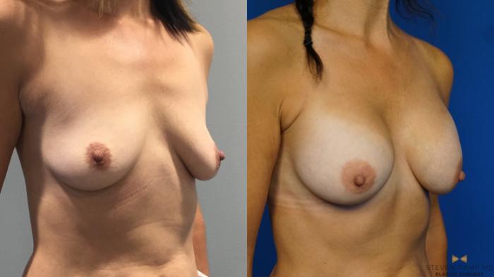 Before & After Breast Augmentation Case 347 Right Oblique View in Fort Worth & Arlington, Texas